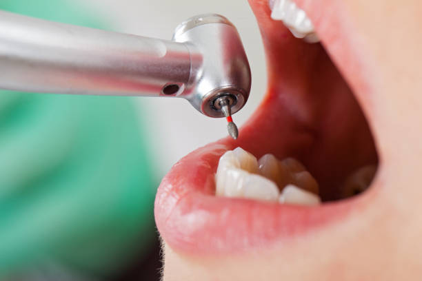Best Emergency Tooth Extraction in Ephraim, UT